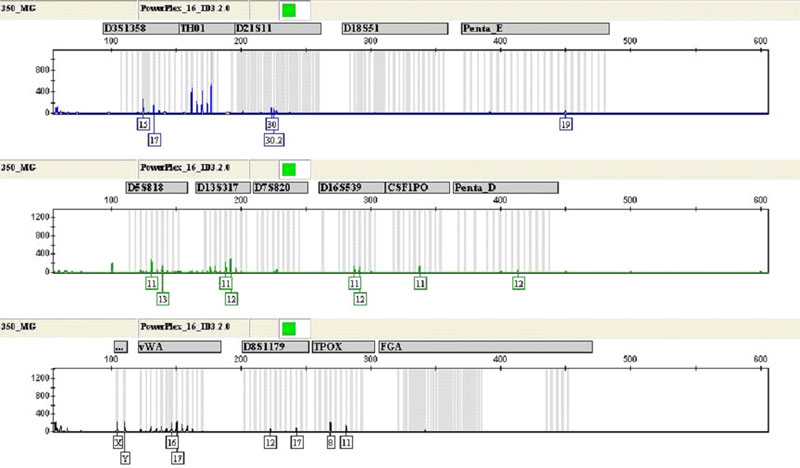 Successful Multiplex Genotyping Of Severely Degraded DNA Extracted From ...